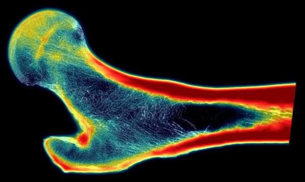 Fracture Risk Score: How to Assess Your Bone Strength